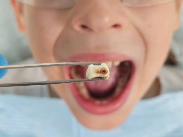 Best Root Canal Emergency Dentist  in Cathcart, WA